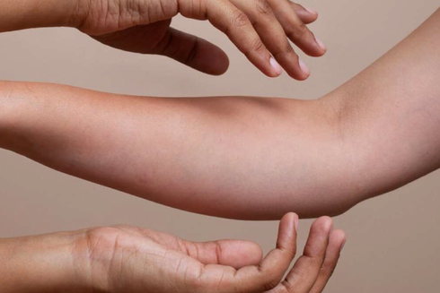 Prevención y manejo de brotes de psoriasis