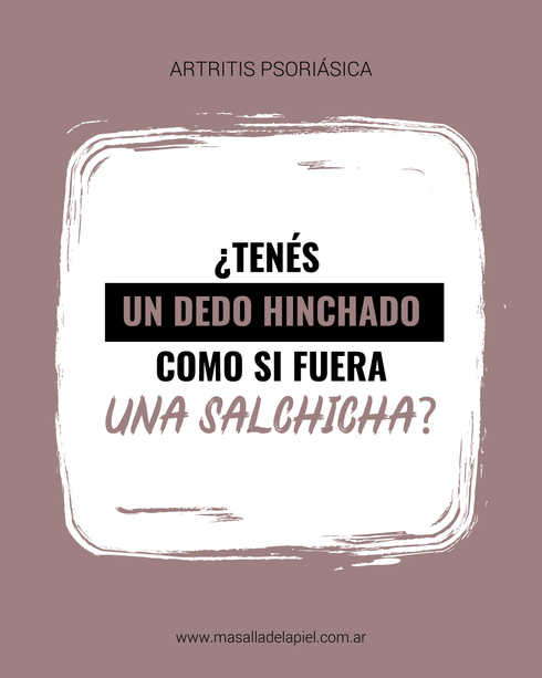 Imagen ilustrativa sobre map dedo salchicha