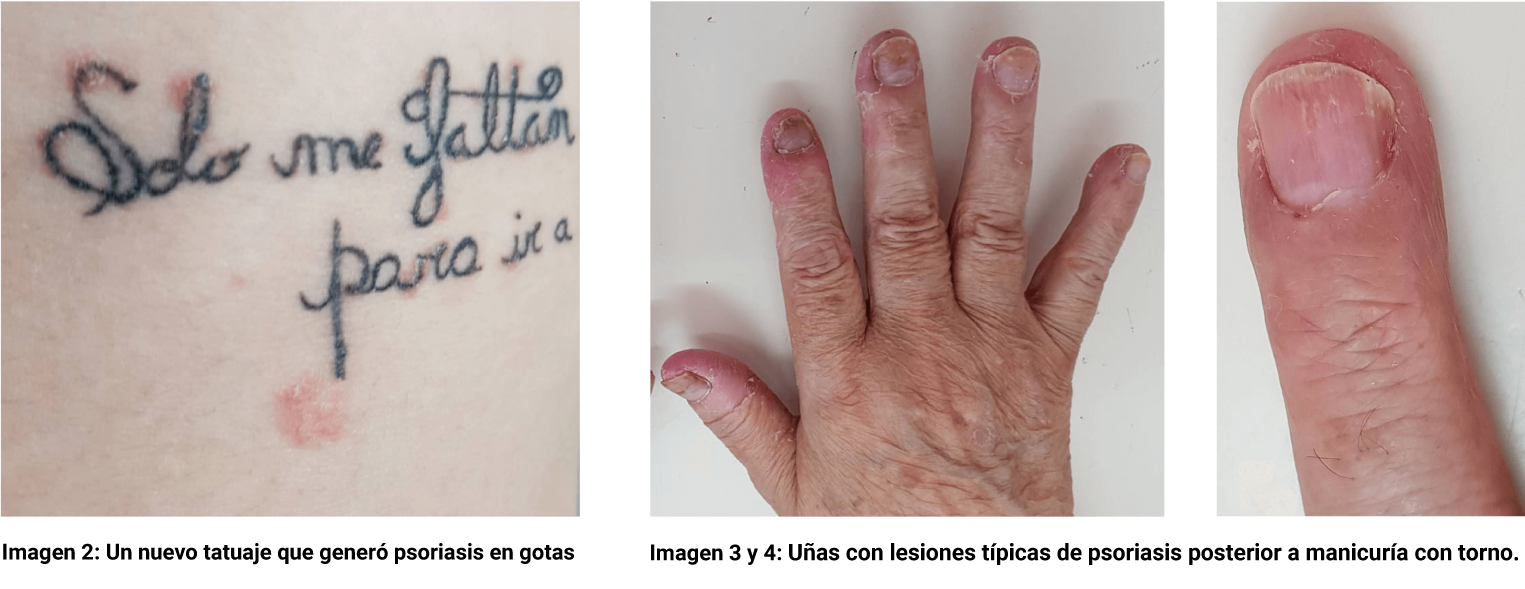 Imagen 2: Un nuevo tatuaje que generó psoriasis en gotas. Imagen 3 y 4: Uñas con lesiones típicas de psoriasis posterior a manicuría con torno.