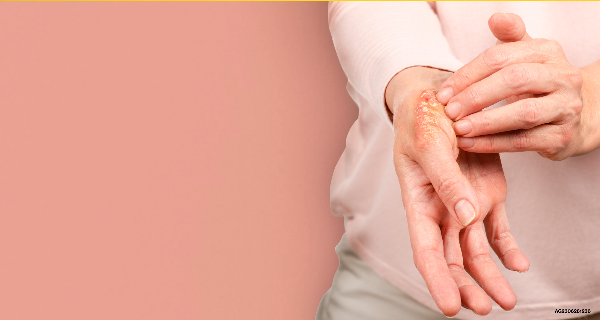 Artritis Psoriásica - Inicio