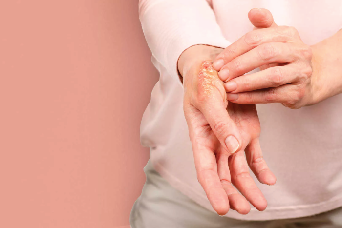 Artritis psoriásica