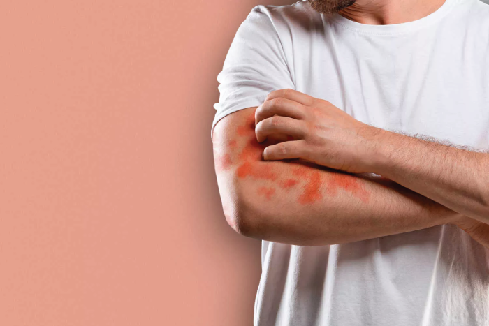 Síntomas de la Artritis Psoriásica