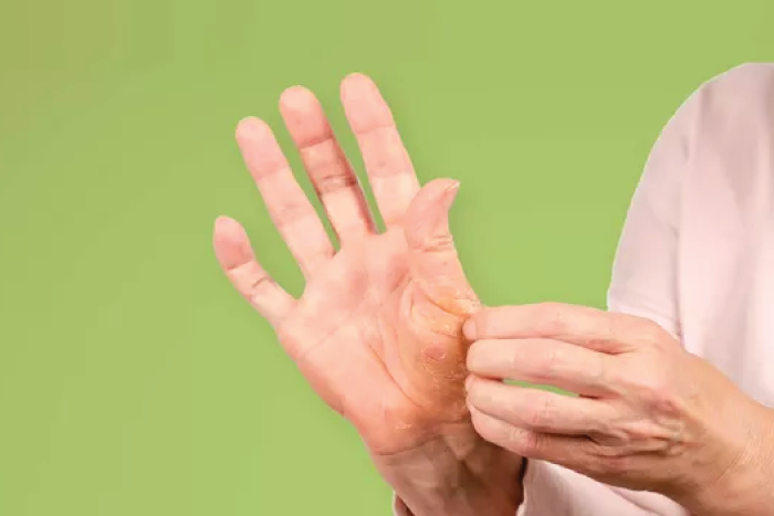 Psoriasis Qué es