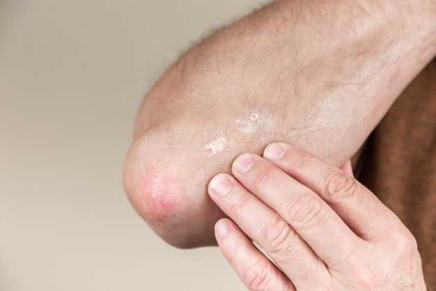 como se diagnostica la psoriasis como se diagnostica la psoriasis
