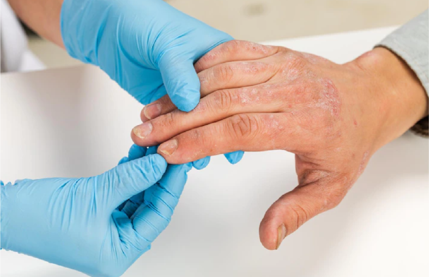 psoriasis y sindrome metabólico psoriasis y sindrome metabólico