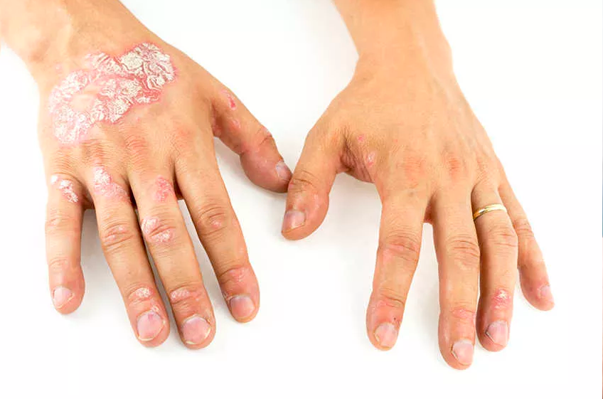 psoriasis síntomas piel seca y agreteada psoriasis síntomas piel seca y agreteada