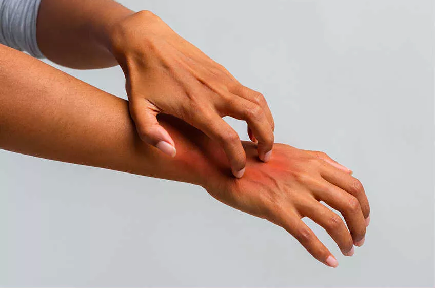 psoriasis síntomas picazón