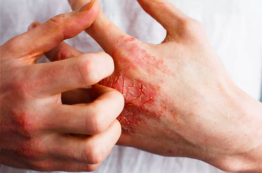 psoriasis síntomas placas rojas psoriasis síntomas placas rojas