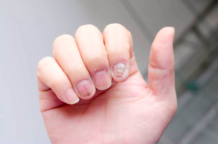 psoriasis síntomas uñas gruesas y amarillas