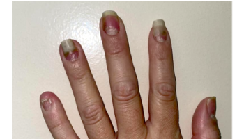 Imagen 4. Compromiso con diversidad de afección de la matriz y lecho ungueal