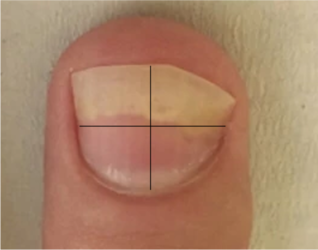 Imagen 5. NAPSI. Se generan 4 cuadrantes y en cada uno de ellos se evalúa si hay lesiones de la matriz o el lecho ungueal