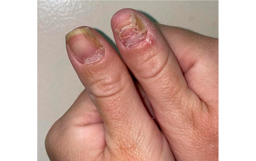 Compromiso de la matriz ungueal