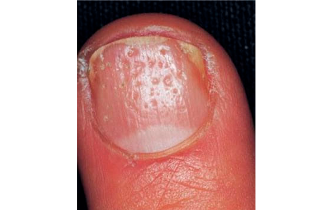 Pitting en uñas de mano