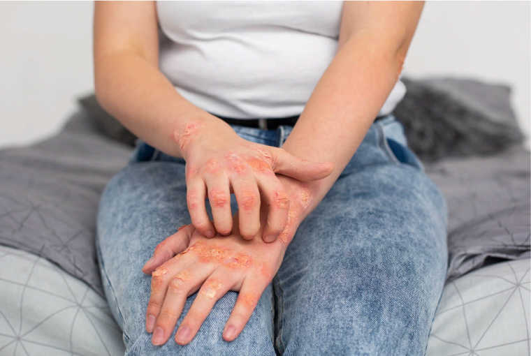 Tratamiento de la dactilitis