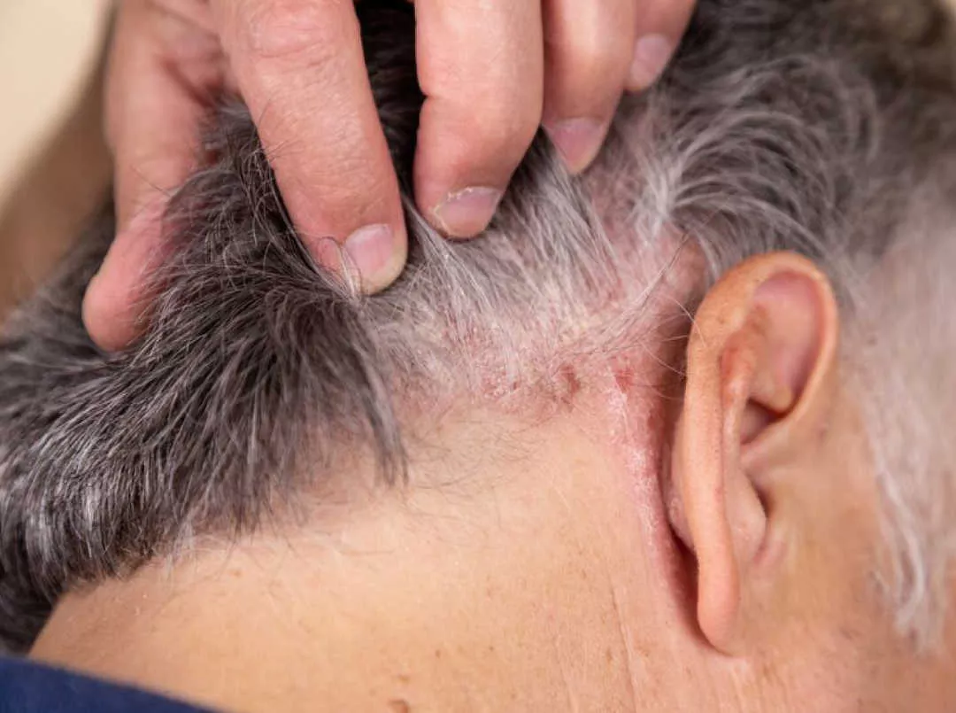 Imagen ilustrativa psoriasis cuero cabelludo