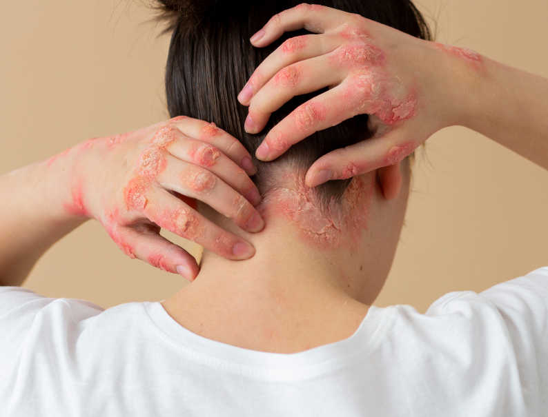 Imagen ilustrativa psoriasis guttata