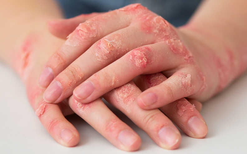 Imagen ilustrativa psoriasis en placas