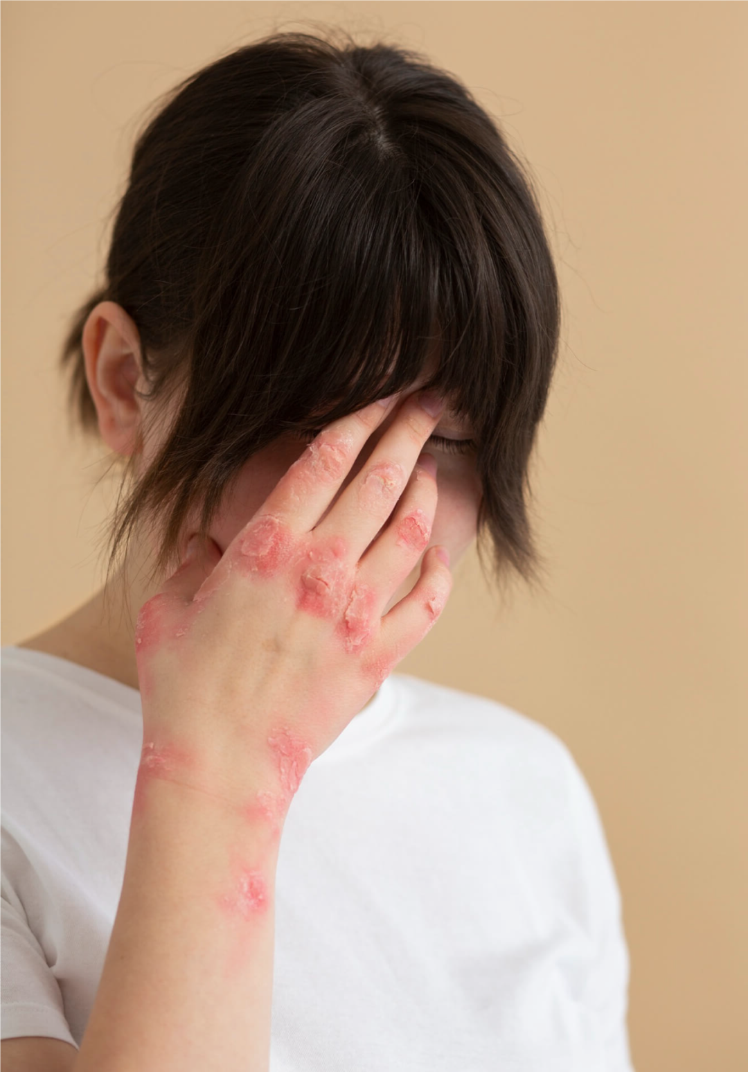 Imagen ilustrativa percepcion emocional de la enfermedad psoriasica