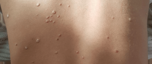 Niño de 10 años que presenta en el dorso, brote de psoriasis en gotas. Imagen aportada por la autora con consentimiento del paciente y sus tutores.