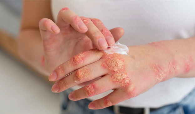 Tratamiento tópico para la psoriasis